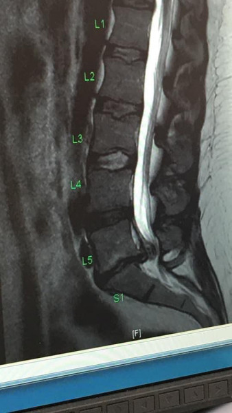 Could this be cauda equina