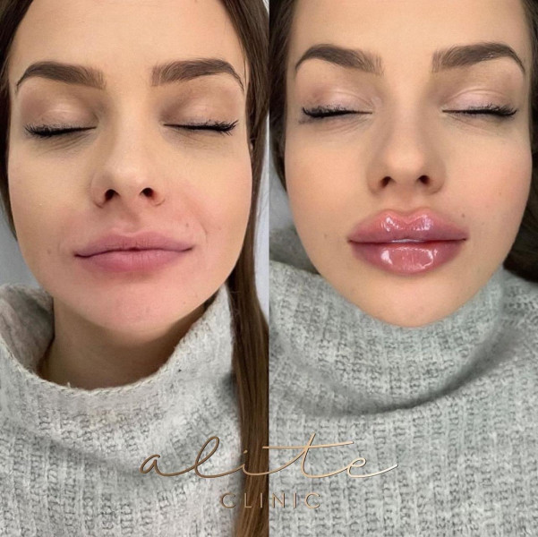 That beauty ‘trends’ are trying to make us all look like sex dolls?