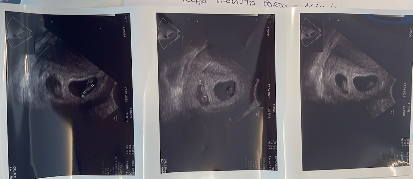 BFPs following IVF to take symptoms & scans