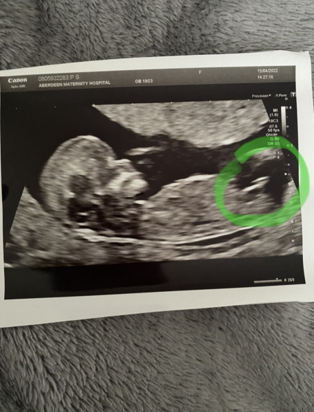 Navigating pregnancy after loss thread 2