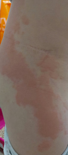 Awful urticaria / hives & high temp 5yo