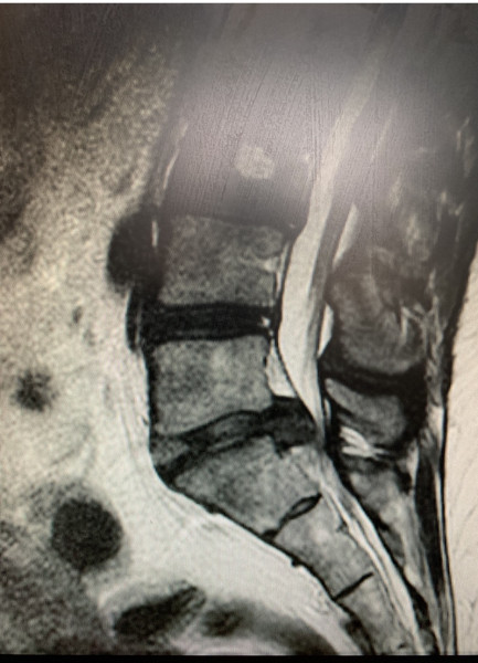 Could this be cauda equina