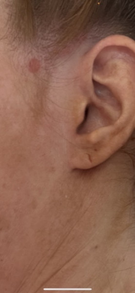 Is this. Normal mole?