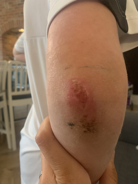 Son's elbow graze not healing