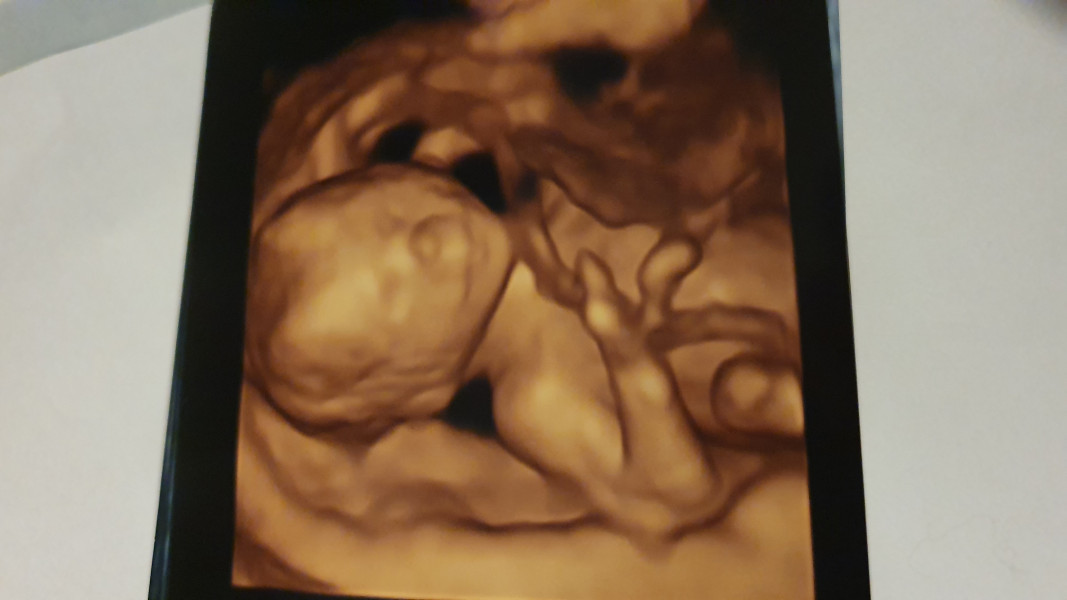 Should i be worried about my baby's development from this scan photo