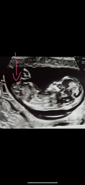 Navigating pregnancy after loss thread 2
