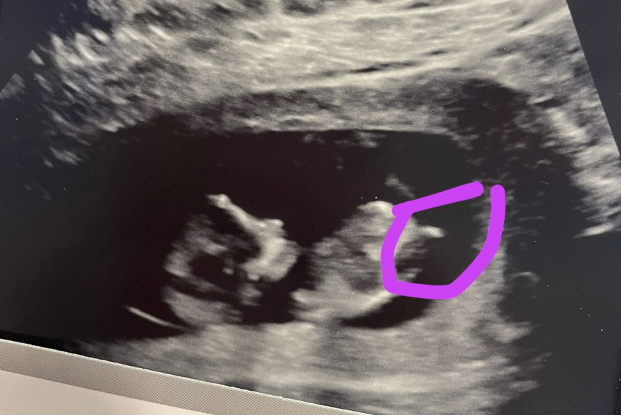 Navigating pregnancy after loss thread 2