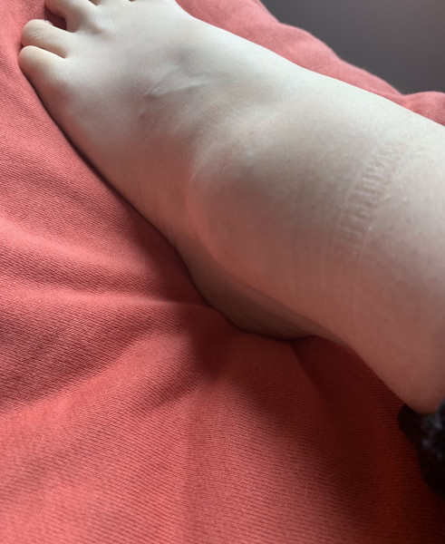 Ankle ligament recovery, normal or not? 
