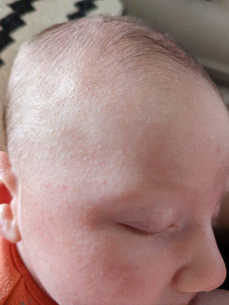 Newborn rash