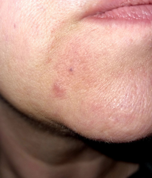 What is this thing that's appeared on my face??