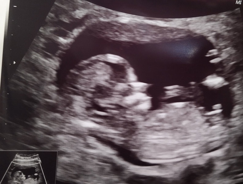 Nub boy or girl guesses?