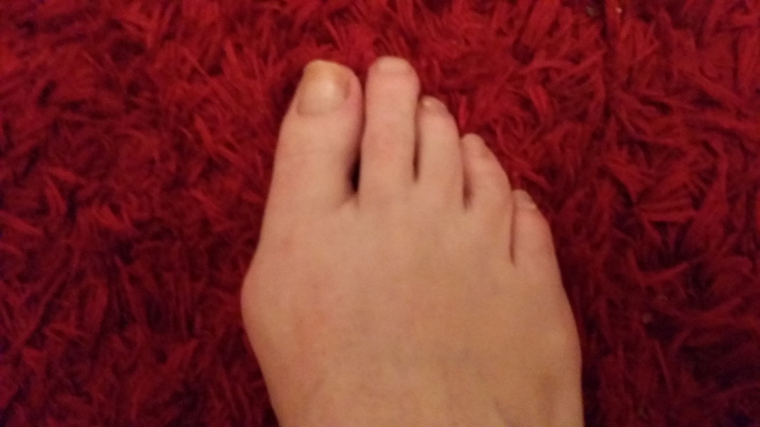 Fucking bunions