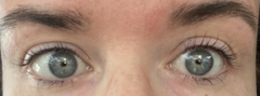 PLEASE HELP! Allergic reaction to eyelash lift and tint