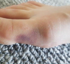 Bruising on sides of big toe with photos