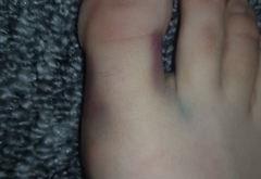 Bruising on sides of big toe with photos