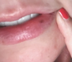 Mole on lip (I think!) pic attached