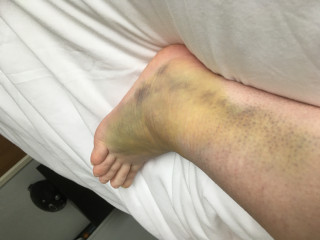 Ankle ligament recovery, normal or not? 