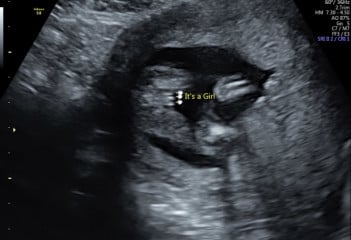 Wrong Gender scan
