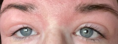PLEASE HELP! Allergic reaction to eyelash lift and tint