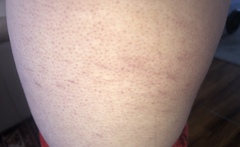 Strange purple lines on side of thigh *pic attached*