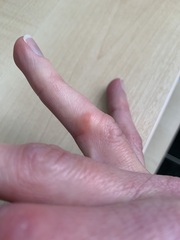 Swollen knuckle - what could it be?