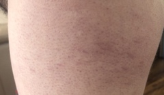 Strange purple lines on side of thigh *pic attached*