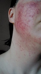 Rosacea Type 2 - Soolantra/Ivermectin/Dermatica