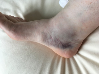 Ankle ligament recovery, normal or not? 