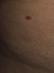 Slight scabbing freckle/mole