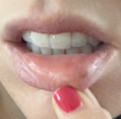 Mole on lip (I think!) pic attached