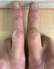 Swollen knuckle - what could it be?