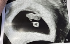 BFPs following IVF to take symptoms & scans