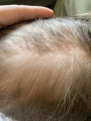 Toddler hair loss