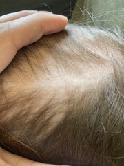 Toddler hair loss