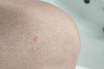Itchy spots, what are they?!