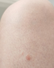 Itchy spots, what are they?!