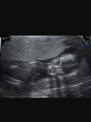 Navigating pregnancy after loss thread 2