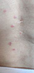 What are these lesion spots on my back? What is my condition. 