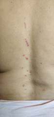 What are these lesion spots on my back? What is my condition. 