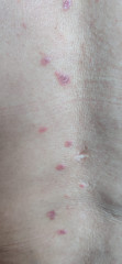 What are these lesion spots on my back? What is my condition. 