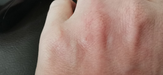 What's biting me 😭😭