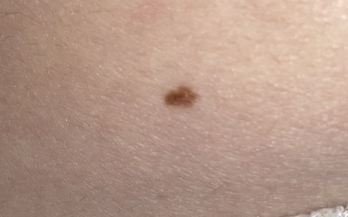 Does this mole look concerning? (Photos)