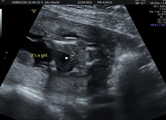 Definitely a boy?