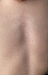 Strange rash on sons chest