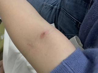What bit me - bed bugs or spiders?! Please help! 