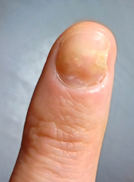 Fungal nail infection or psoriatic nail?