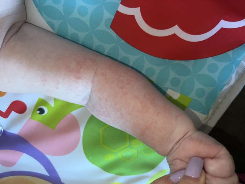 Baby eczema 