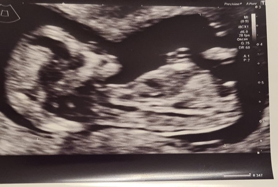 BOY or GIRL Guesses