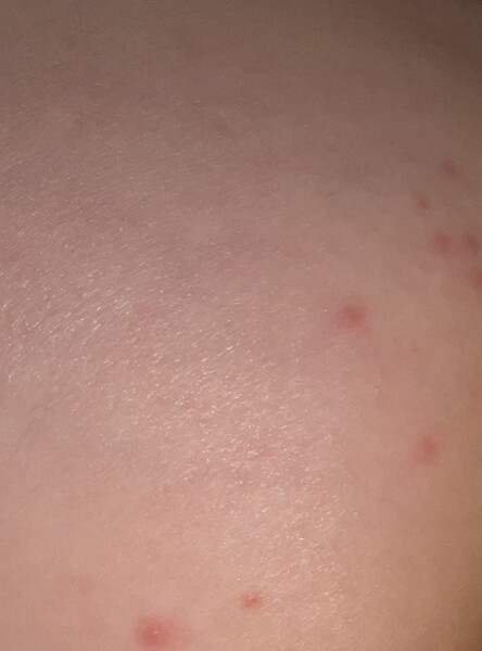 Pimples on toddlers privates what could this be?