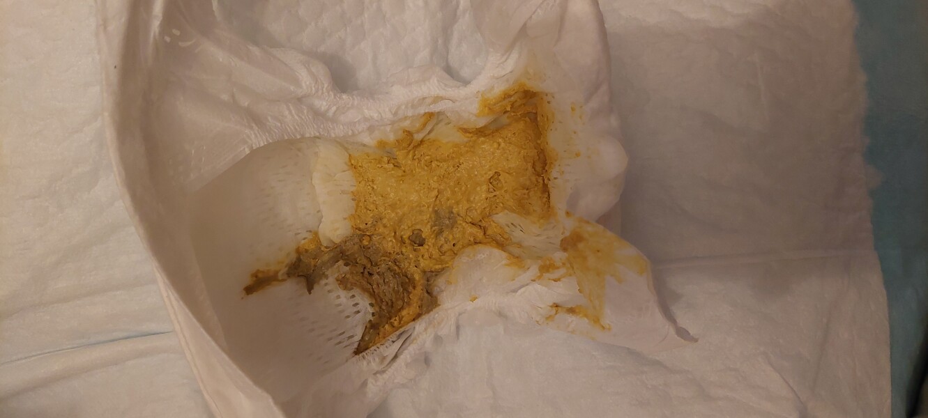 Possible CMPA? *poo picture*